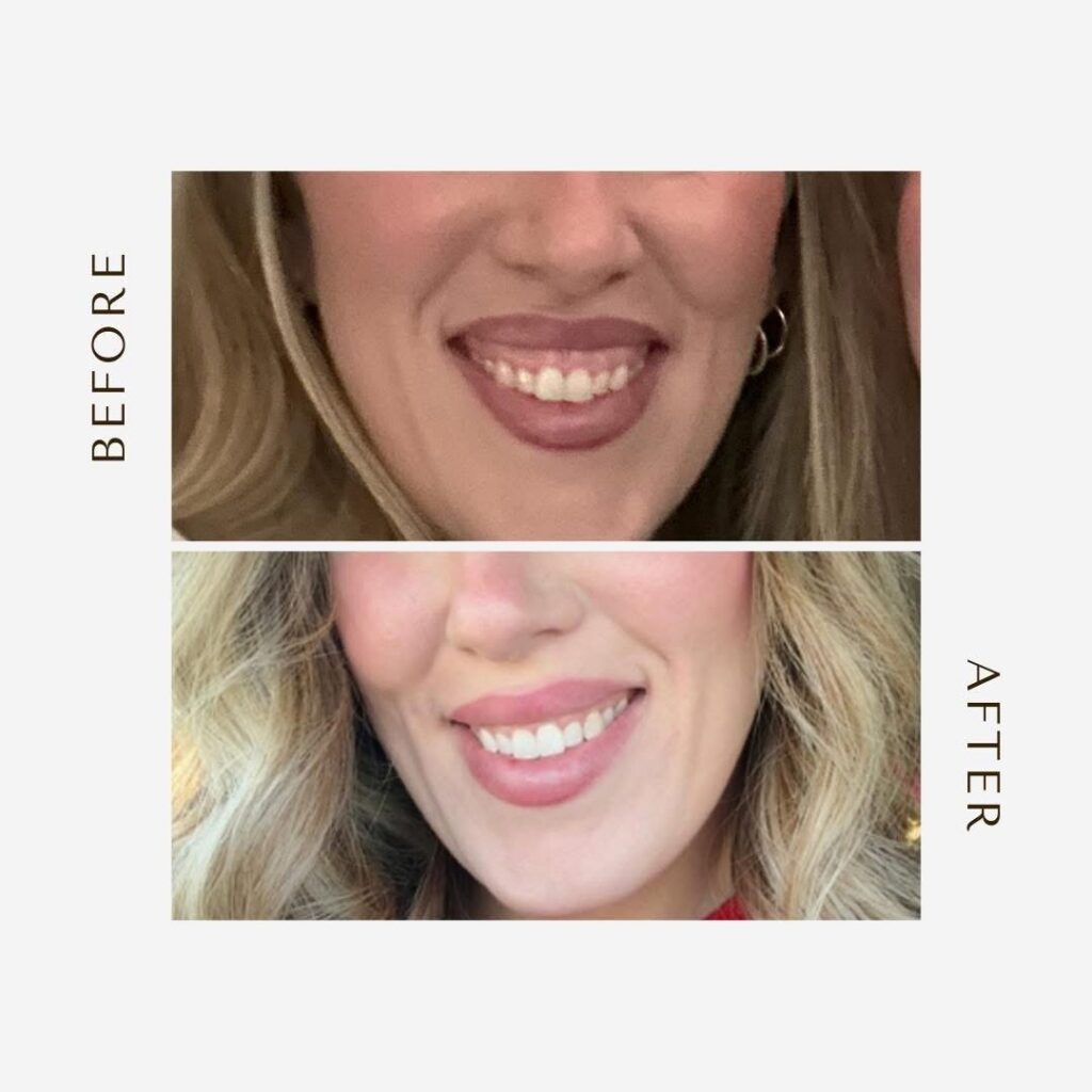 Gummy Smile and Lip Flip with Daxxify