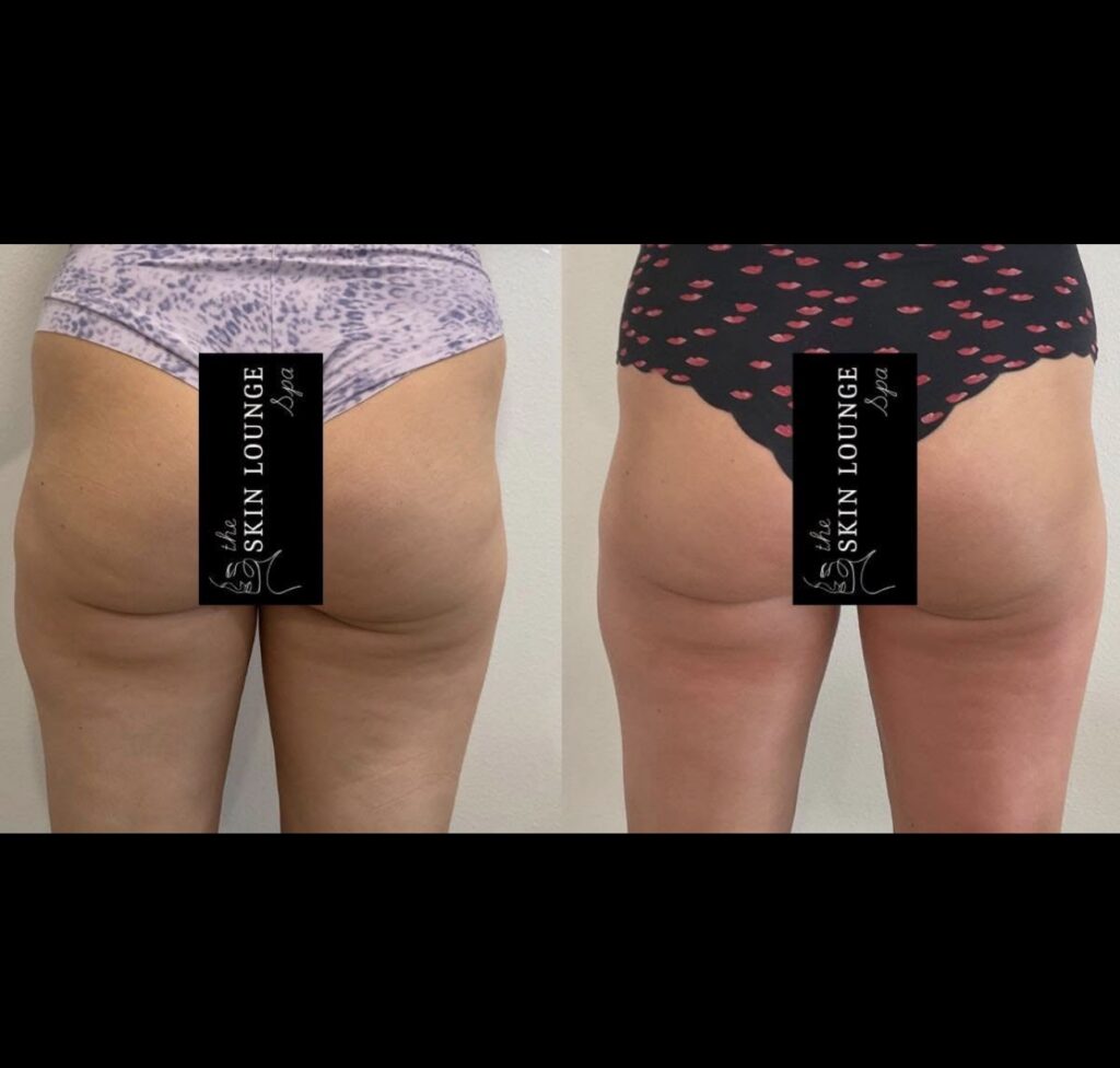 EmTone Cellulite Reduction