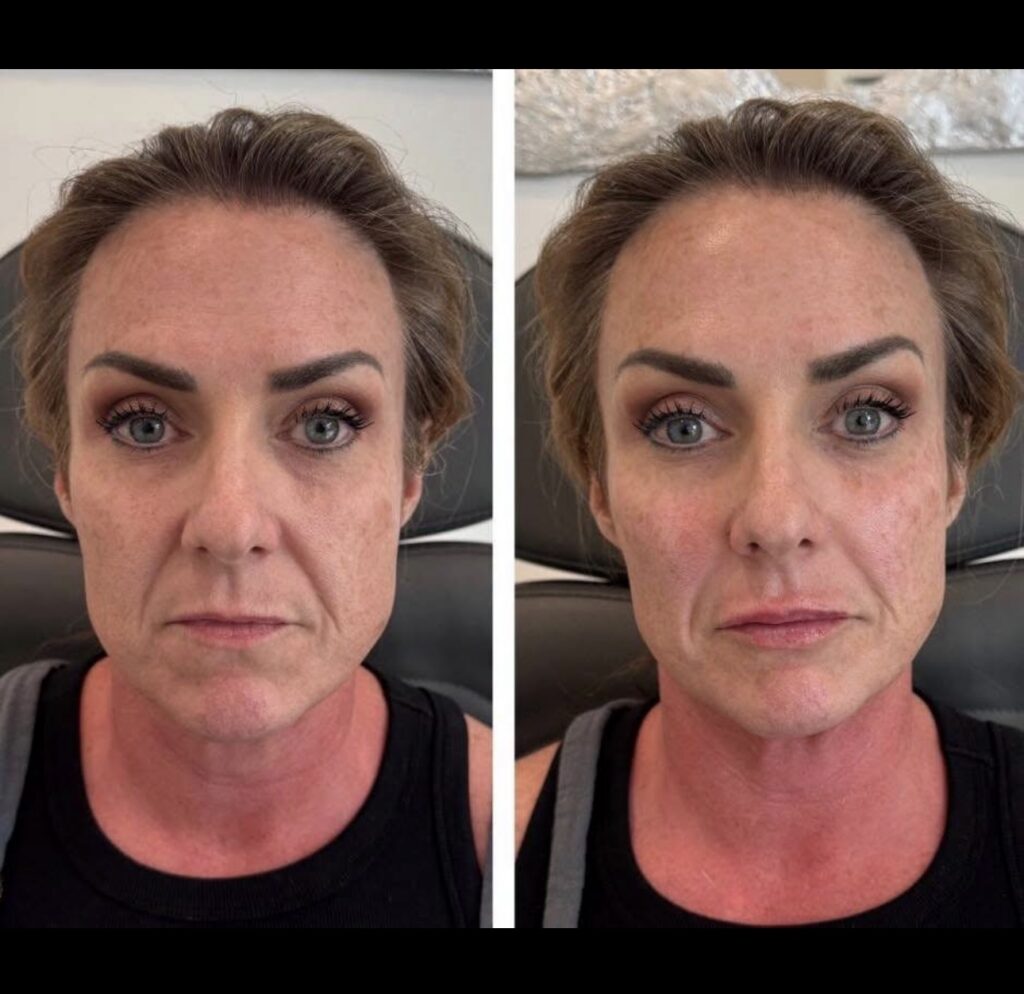 Cheek and lip filler