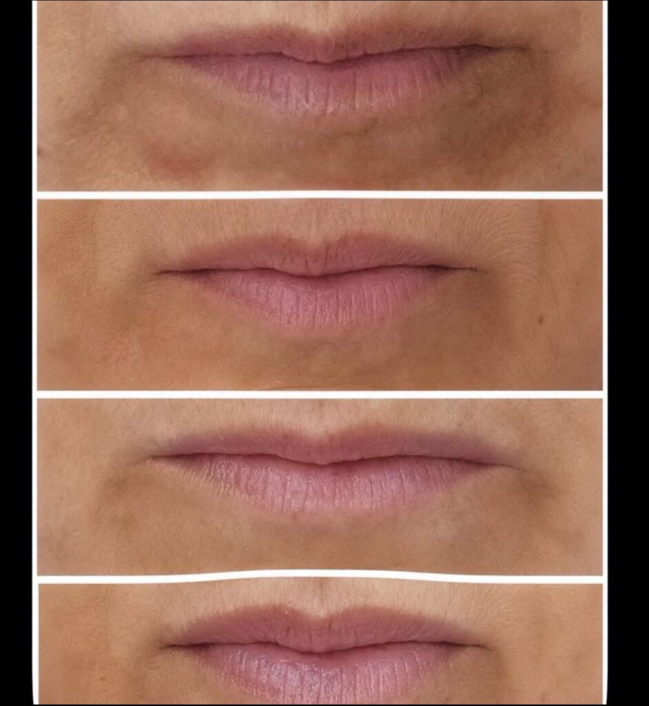 Exion Needle Free Lip Filler