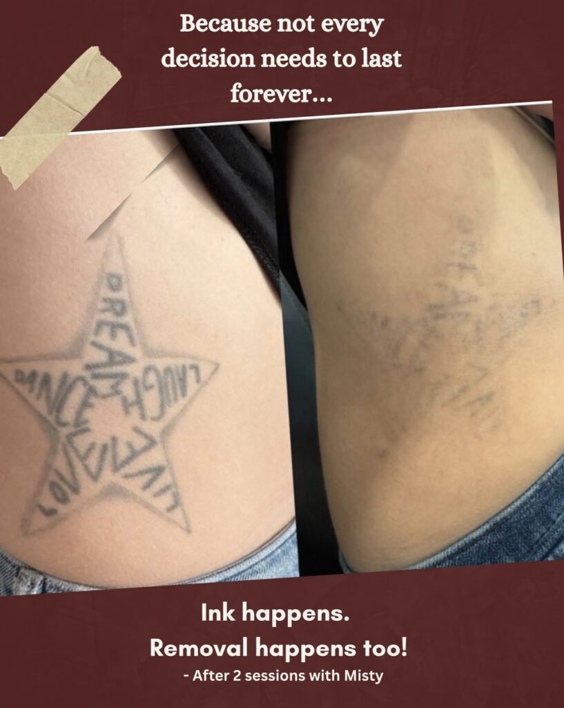 Tattoo removal rib cage